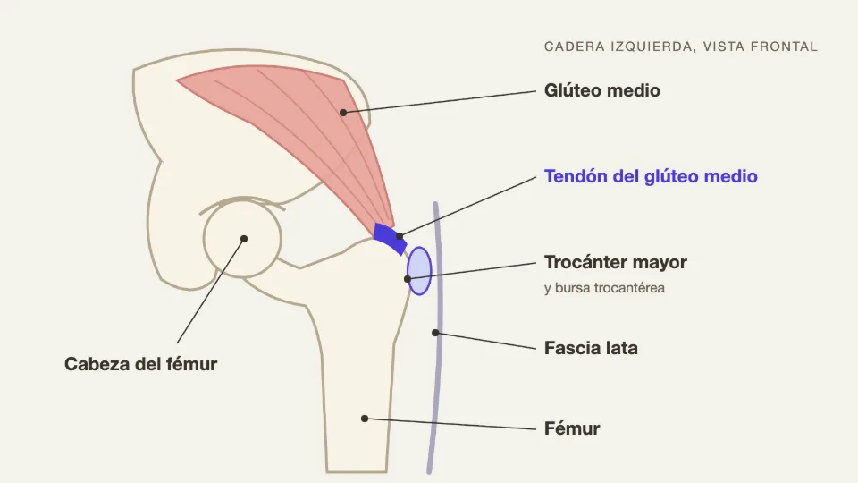 Ilustración del trocánter mayor, el tendón del glúteo medio y la bursa trocantérea en la trocanteritis